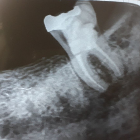 One Visit Root Canal 1