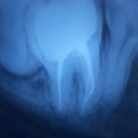 One Visit Root Canal 2