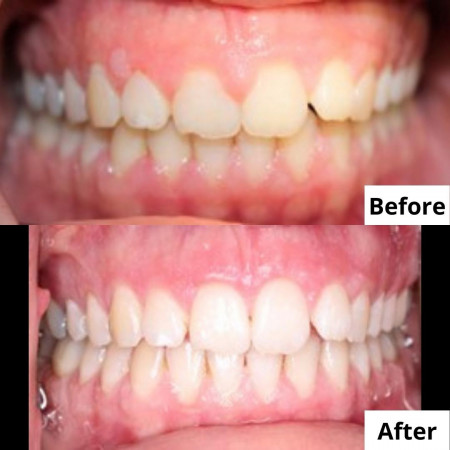 Plastic surgery of gum tissue