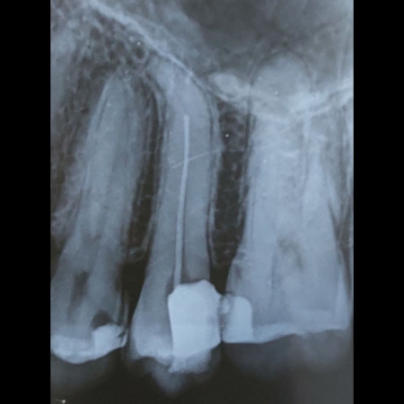 Re-Treatment Case - Before