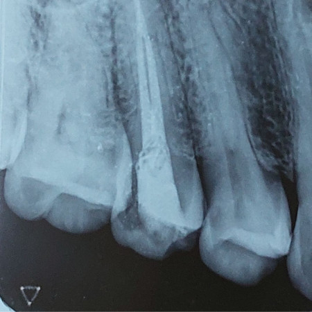 Re-Treatment Case - After