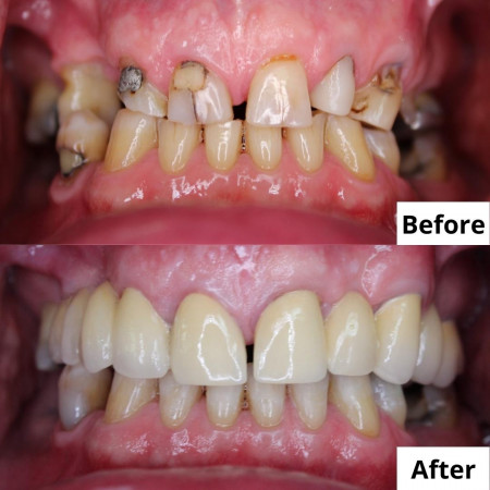 Ceramic Fused to Metal Crowns