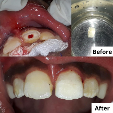 Dental Trauma Management